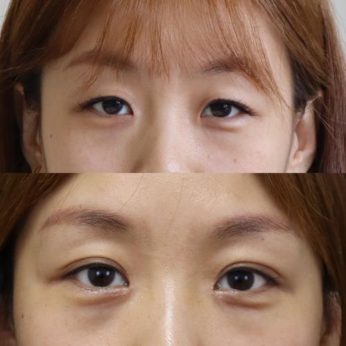 开眼角是什么意思