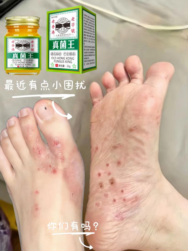 脚脱皮开裂用什么药