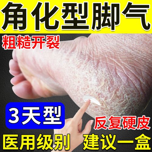 脚脱皮开裂用什么药