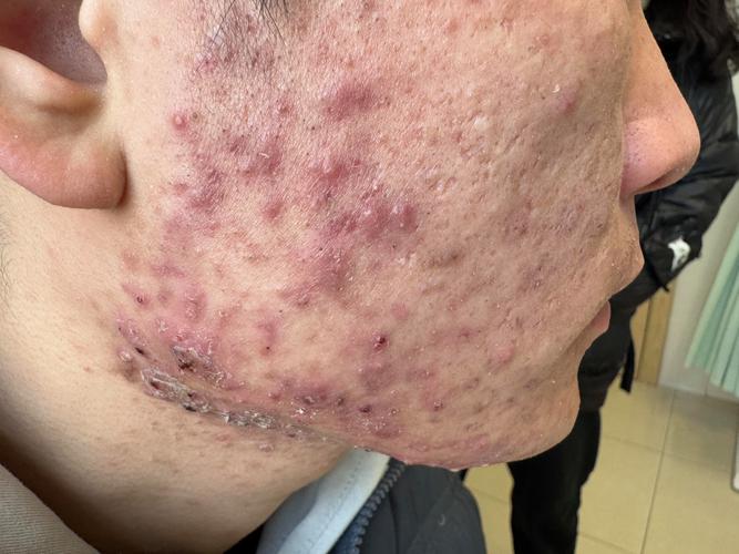 痤疮里面是什么