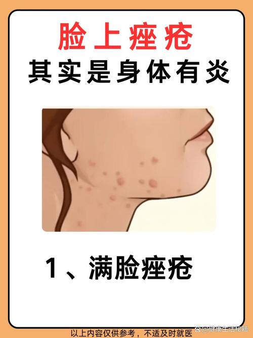 痤疮里面是什么