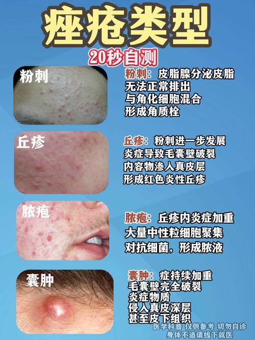 痤疮里面是什么