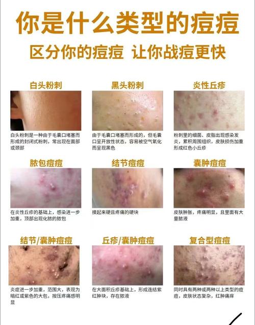 长青春痘是什么原因