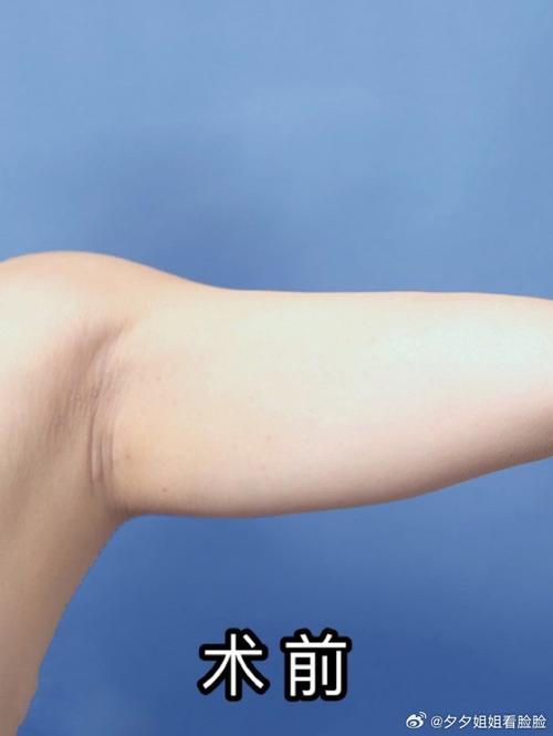 减肥后胳膊松弛抹什么