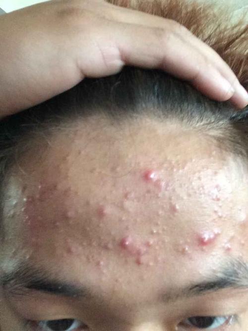 为什么额头上长痘痘