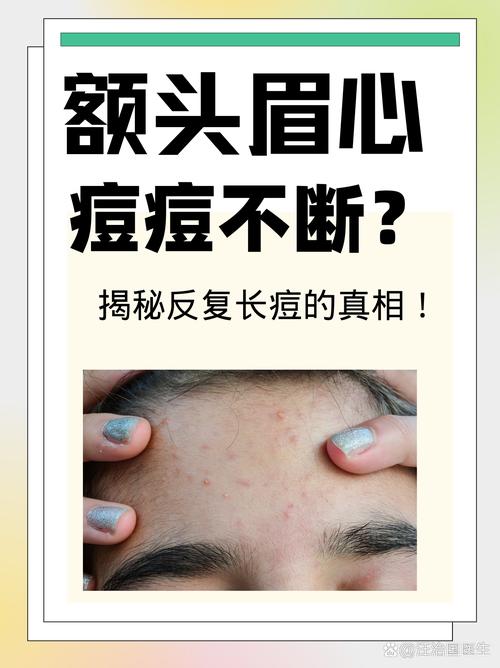 为什么额头上长痘痘