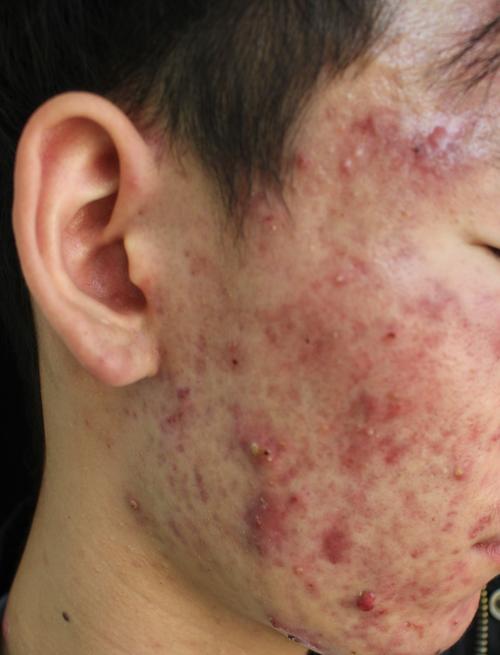 面部痤疮是什么