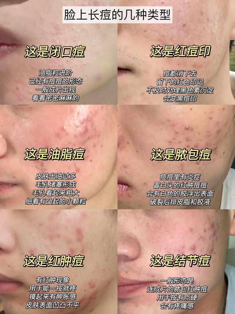 面部痤疮是什么