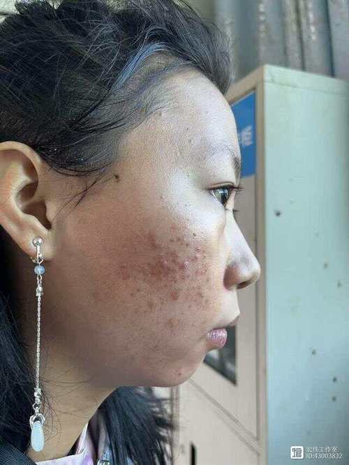 面部痤疮是什么