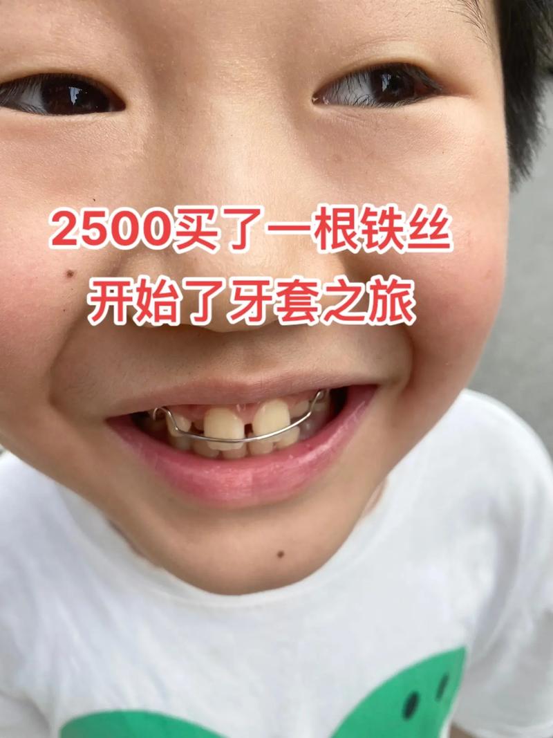 牙套为什么这么贵