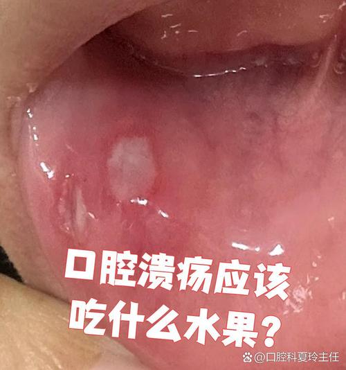 长溃疡吃什么水果