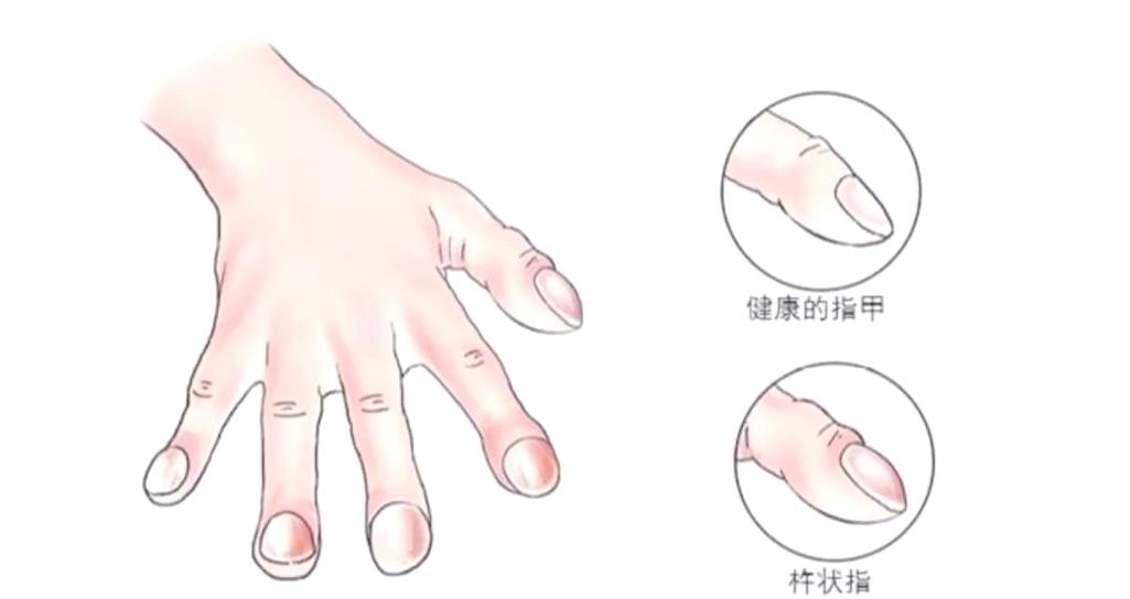 手指粗大是什么病