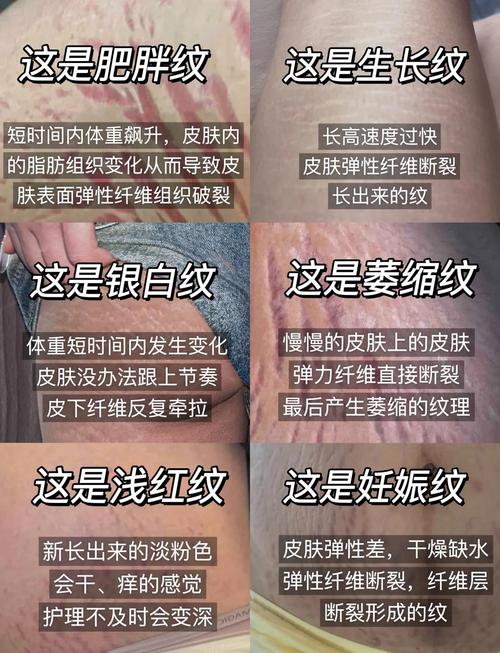 为什么减肥下来会有纹