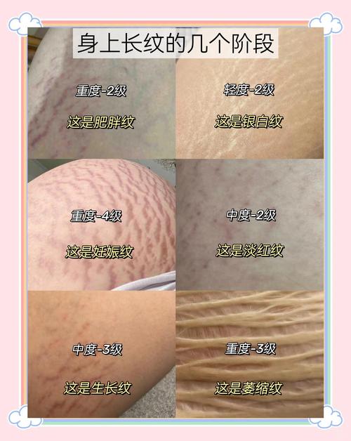 为什么减肥下来会有纹