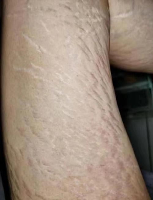 为什么减肥下来会有纹