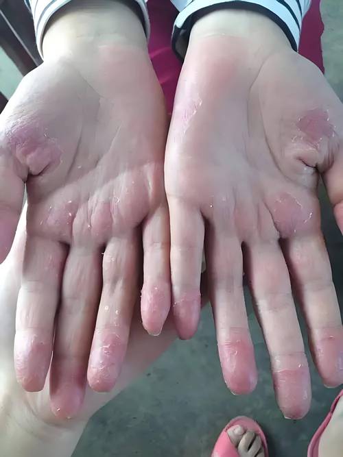 手起皮是缺什么