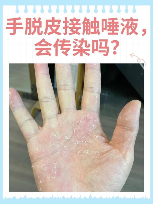 手起皮是缺什么