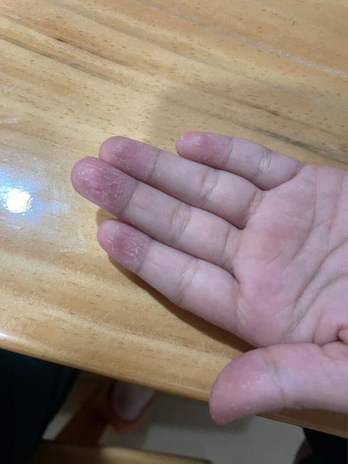 手起皮是缺什么