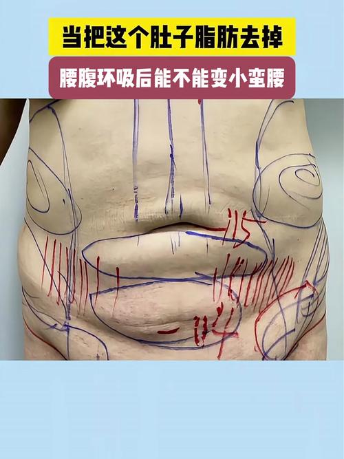 什么是腹部吸脂减肥