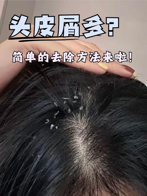 头皮屑多是为什么