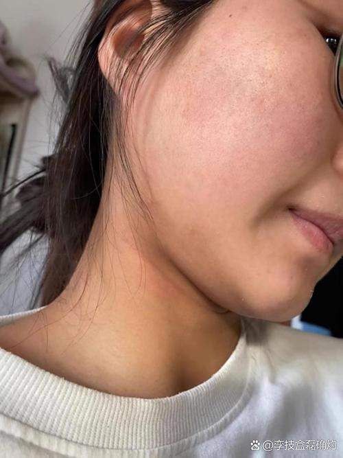 洗面奶洗脸后皮肤刺痛