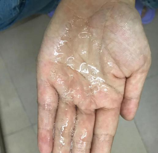 洗面奶洗脸后皮肤刺痛