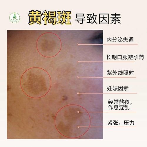 什么是黑色素沉淀