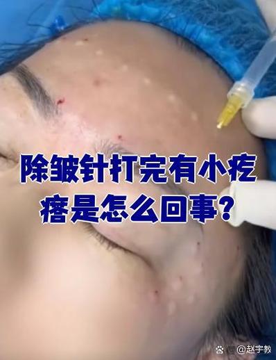 脸过敏打什么针