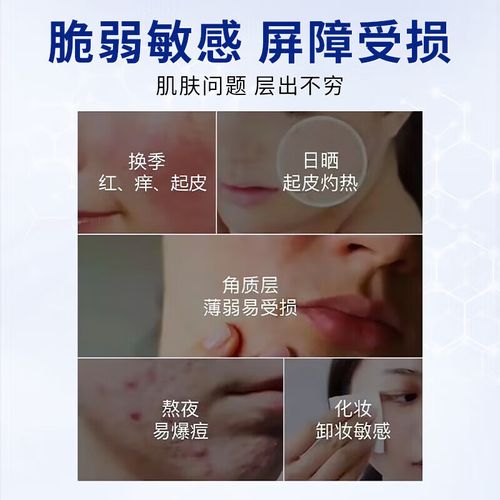 皮肤薄有红血丝用什么护肤品