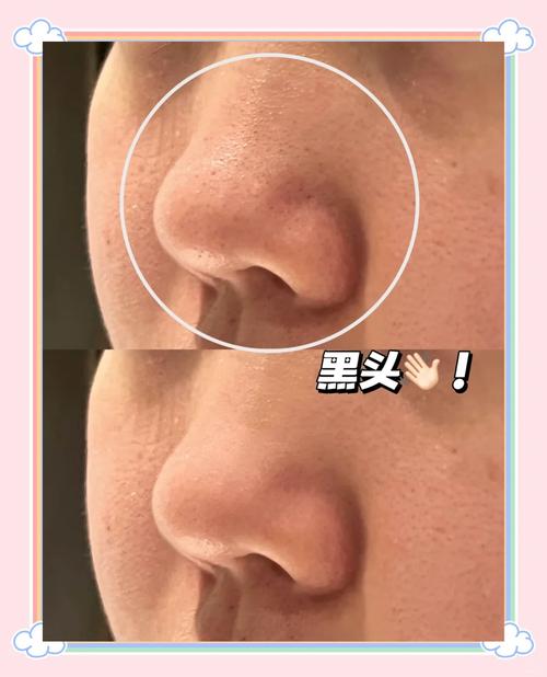 洗面奶感觉去不了黑头