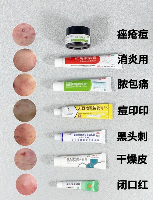 皮肤容易长痘用什么护肤品