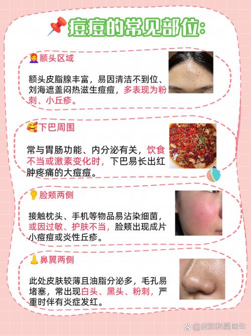 为什么额头会长痘痘