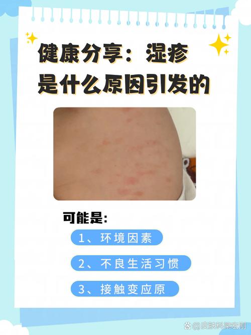 湿疹的症状是什么样的