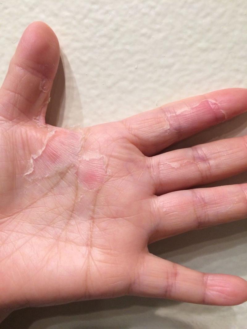 手掉皮是缺什么