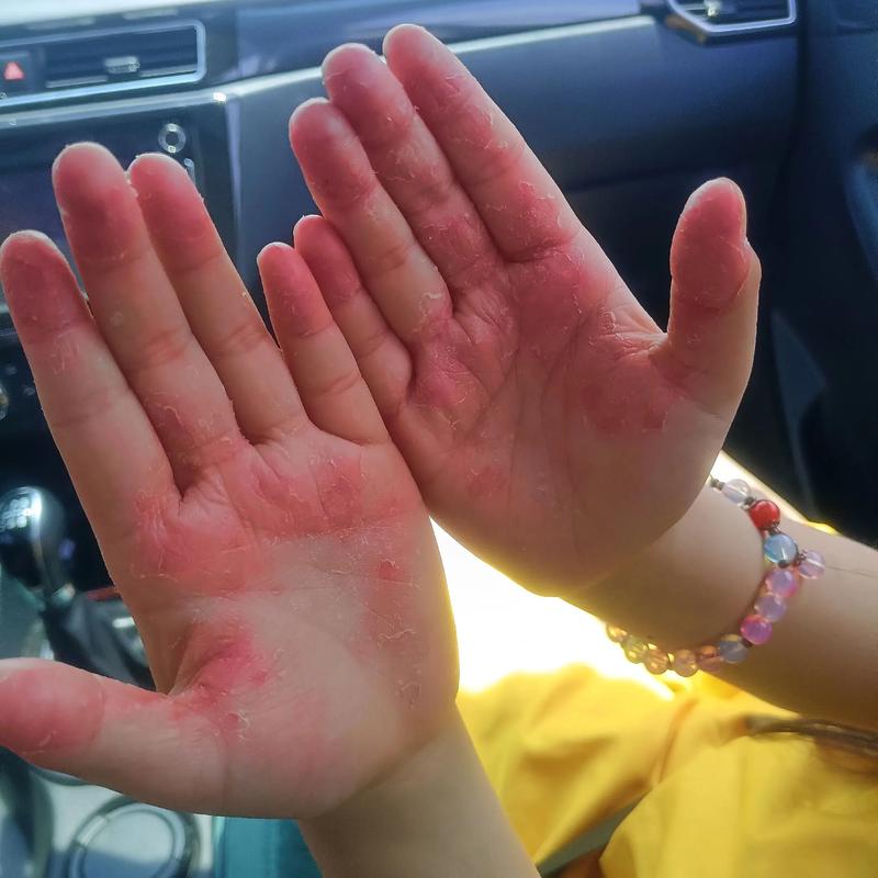 手掉皮是缺什么