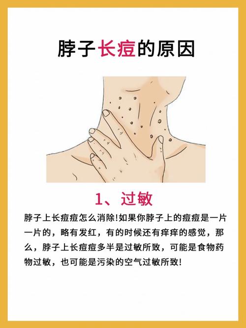脖子长痘是什么原因