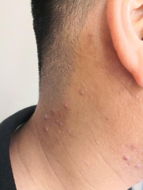 脖子长痘是什么原因