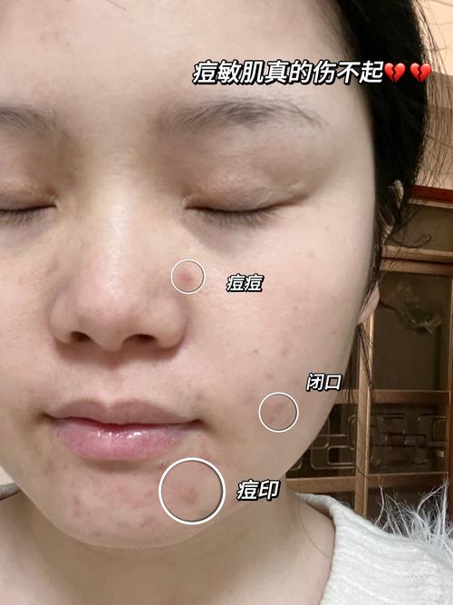 长了痘痘用洗面奶洗脸