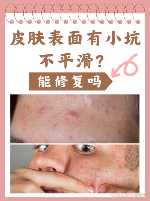 脸上为什么会有坑