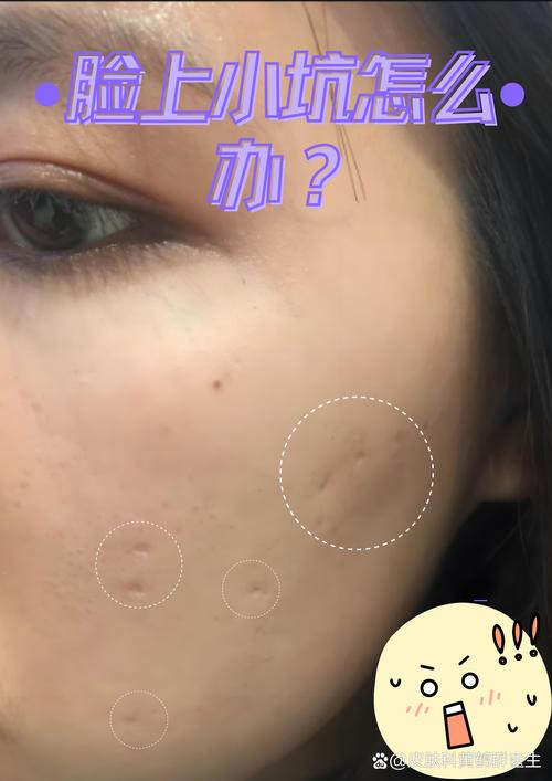 脸上为什么会有坑