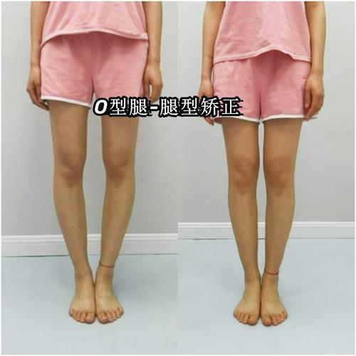 o型腿是什么样的