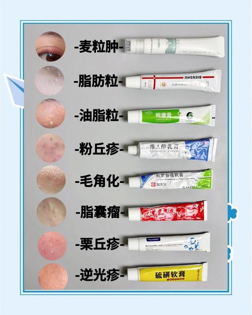 脸上有脂肪粒用什么护肤品