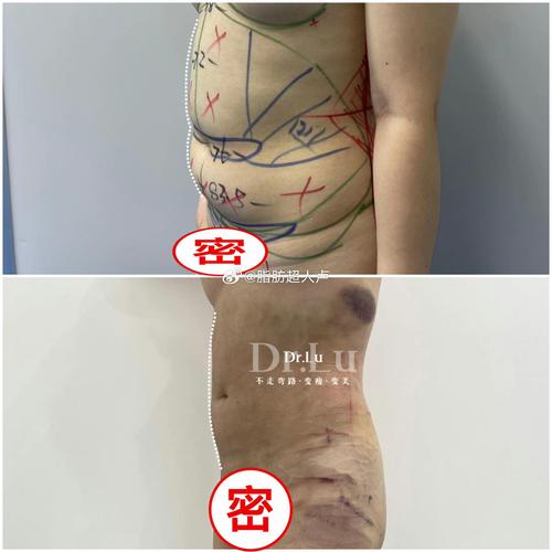 抽脂减肥在什么地方