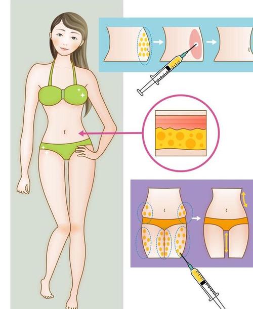 抽脂减肥在什么地方