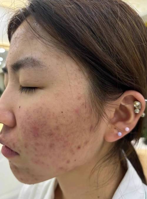 用了洗面奶脸上长疙瘩