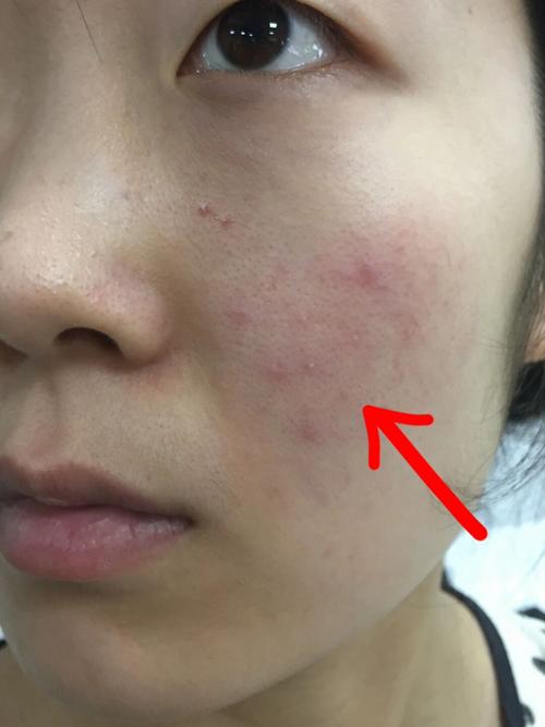 用了洗面奶脸上长疙瘩