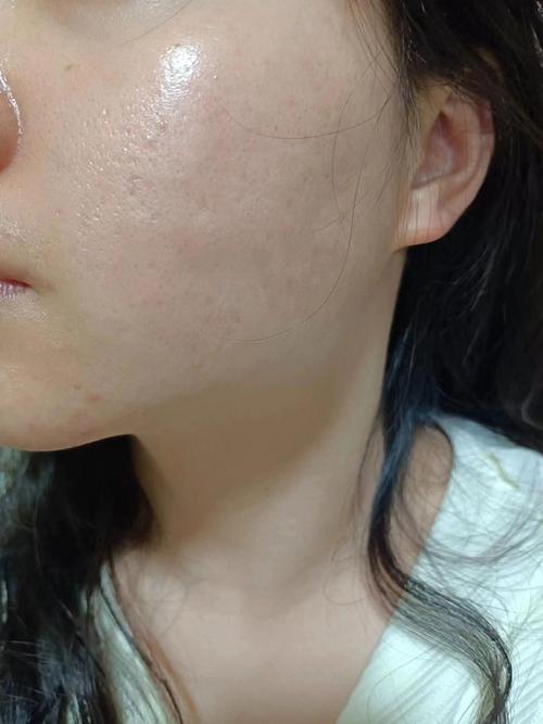 用了洗面奶脸上长疙瘩