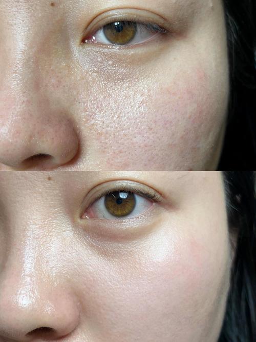 黑头毛孔粗大用什么护肤品