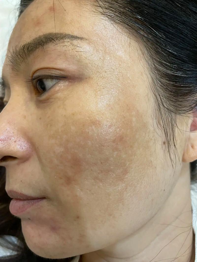 黄褐斑是什么样