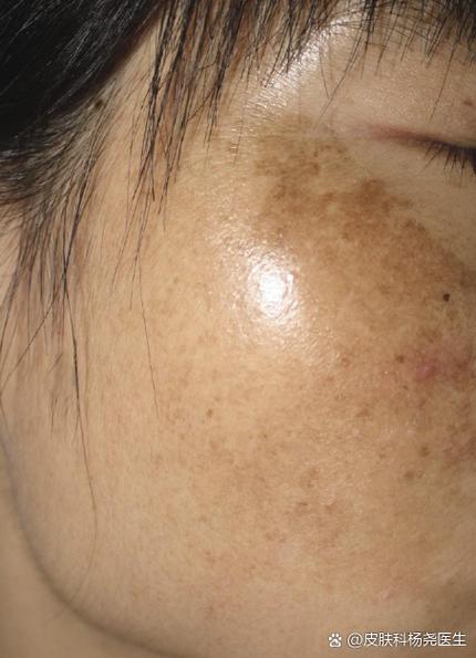 黄褐斑是什么样